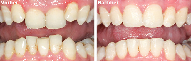 quarree-dental-sms-vorher-nacher-6