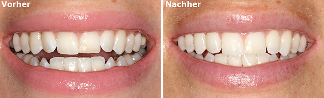 quarree-dental-sms-vorher-nacher-5