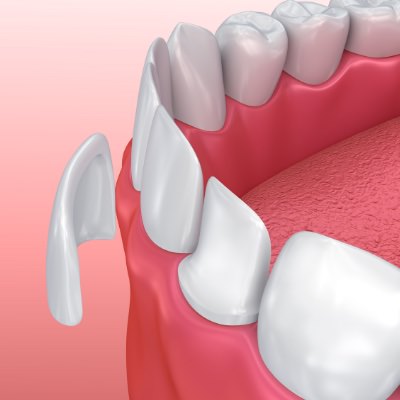 Veneers 2 Leistungen