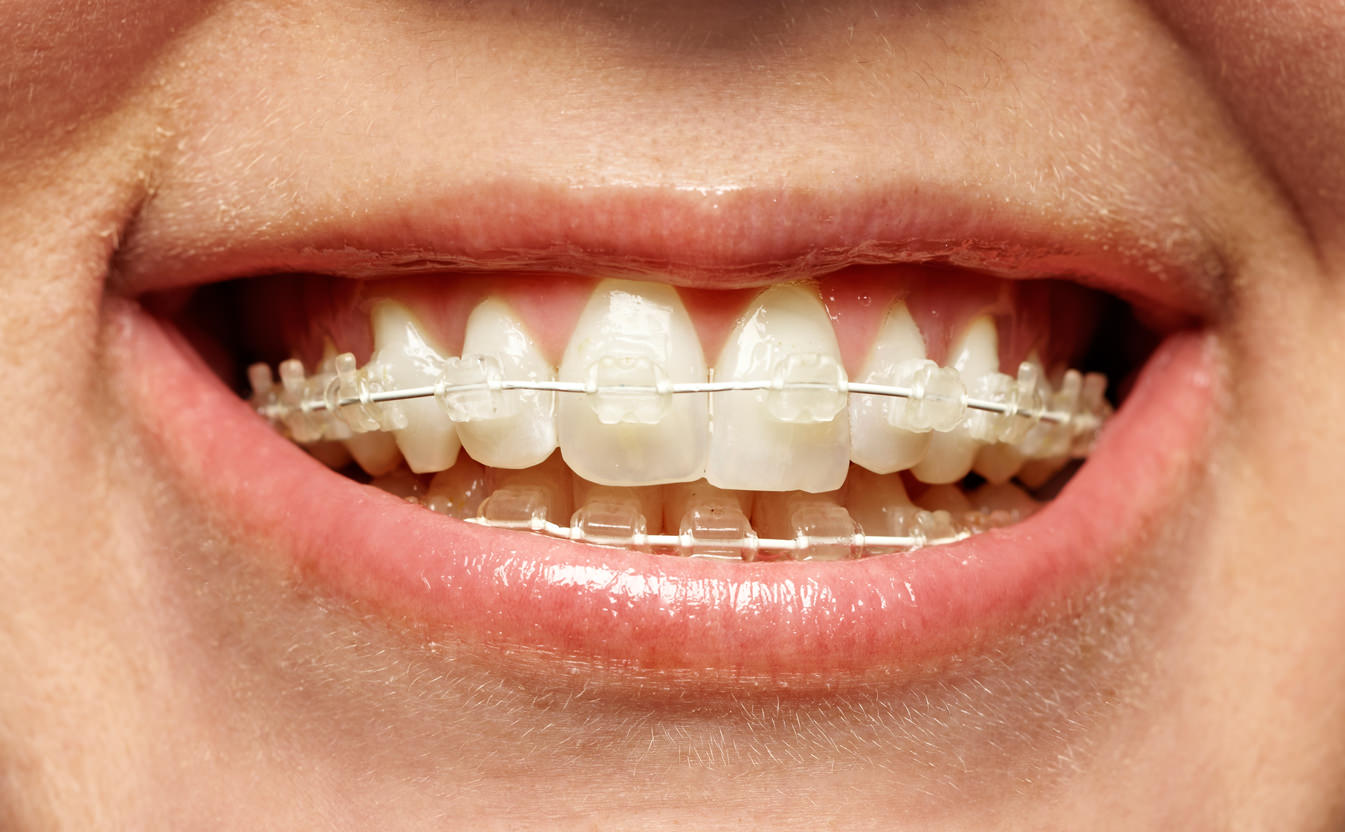 Ästhetische Kieferorthopädie für Erwachsene 2 Leistungen