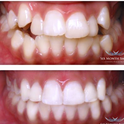 Feste (fast) unsichtbare Zahnspange 2 Leistungen