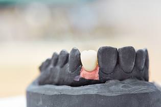 hochwertiger Zahnersatz durch Keramik- und Prozellanimplantate