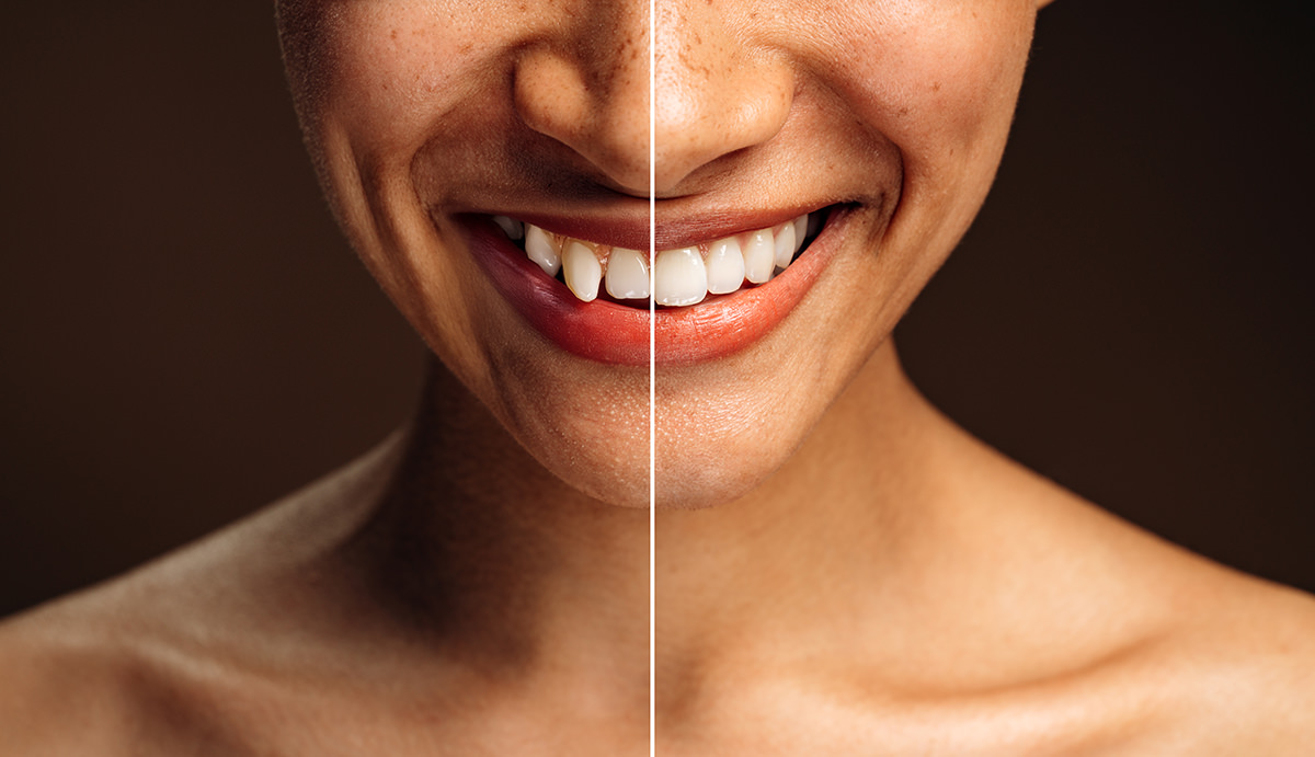 Clear Aligner 2 Leistungen