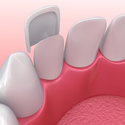 Veneers 3 Leistungen